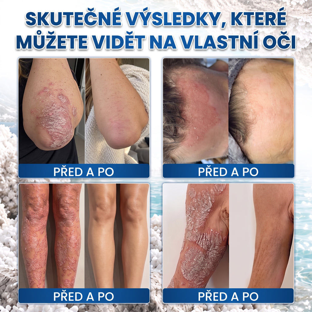 Medistart® PSZORIÁZIS SPECIÁLIS BŐRÁPOLÓ