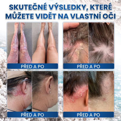 Medistart® PSZORIÁZIS SPECIÁLIS BŐRÁPOLÓ