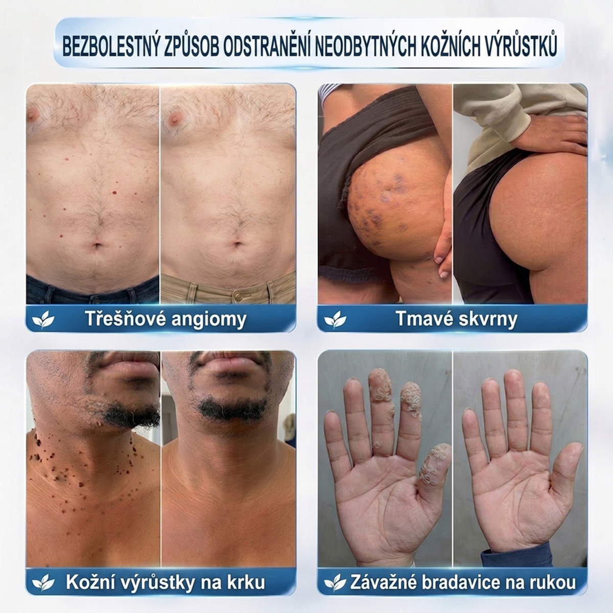 PuraCure® 👩‍⚕️ 𝟕denní Pero na Odstranění Kožních Výrůstků a Skvrn – Bezbolestné Odstranění bez Jizev, Profesionální Roller aplikátor