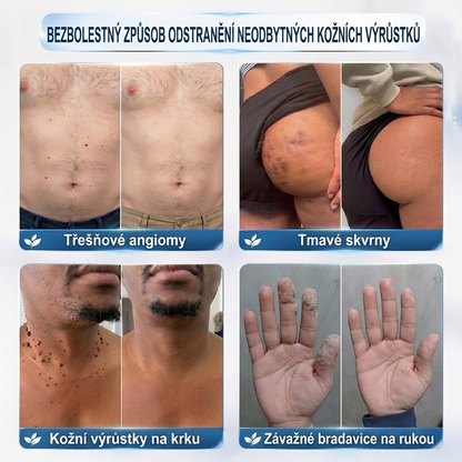 PuraCure® 👩‍⚕️ 𝟕denní Pero na Odstranění Kožních Výrůstků a Skvrn – Bezbolestné Odstranění bez Jizev, Profesionální Roller aplikátor