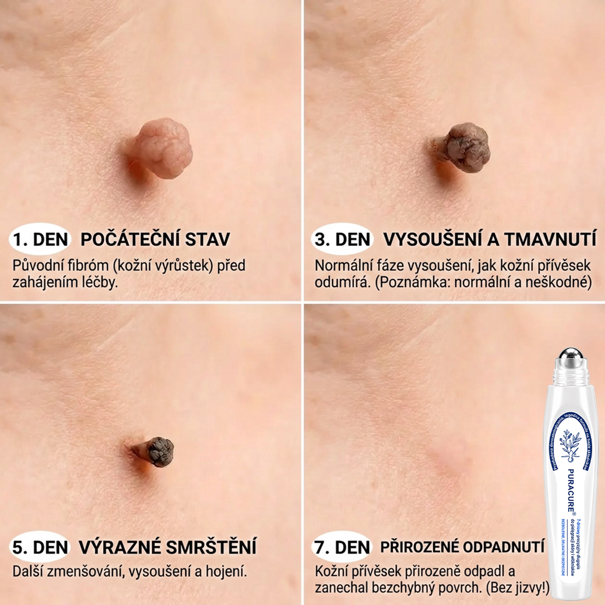 PuraCure® 👩‍⚕️ 𝟕denní Pero na Odstranění Kožních Výrůstků a Skvrn – Bezbolestné Odstranění bez Jizev, Profesionální Roller aplikátor